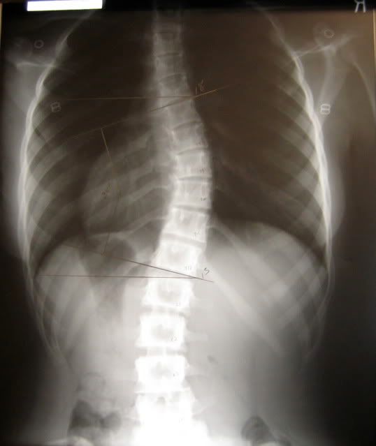 Scoliosis X Ray