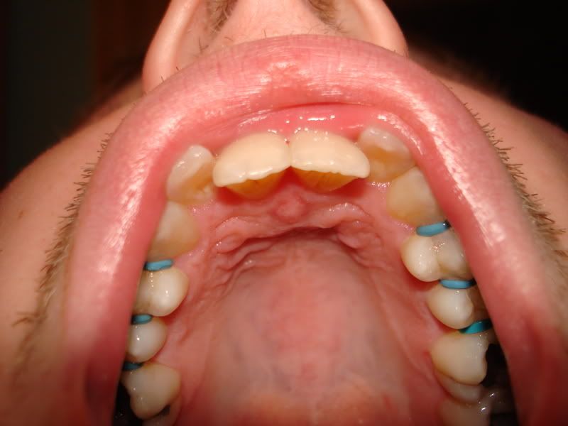 Spacers For Braces. SPACERS: Image