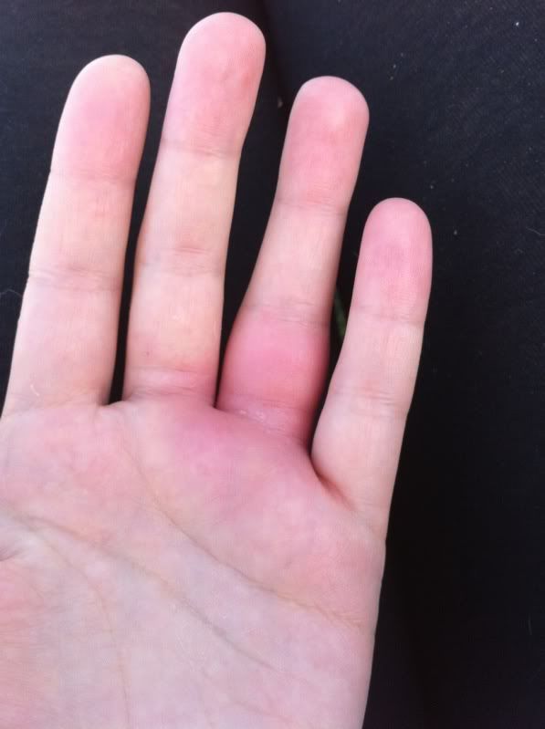 Red bump on finger - Skin Problems Message Board ...