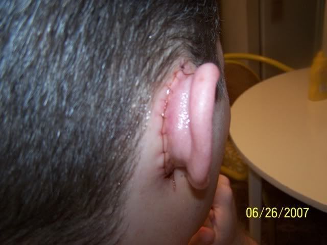 Healed Perforated Eardrum