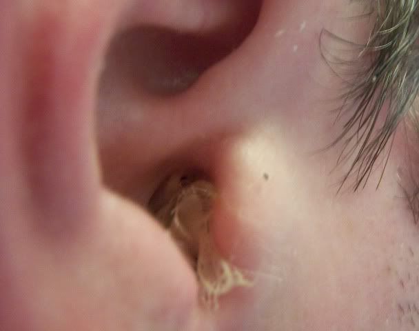 Perforated Eardrum -> Tympanoplasty