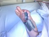 MomsToeGone3.jpg Toe with wound vac in image by codarkone